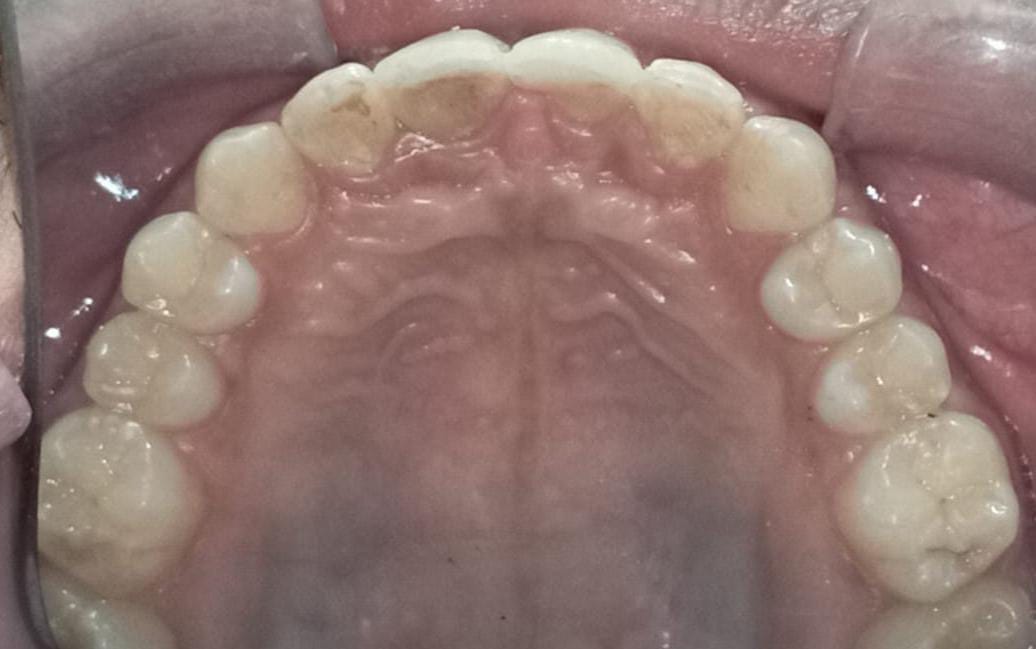 Upper arch after treatment