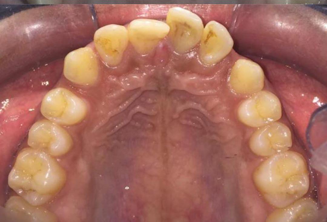 Upper arch before aligner treatment